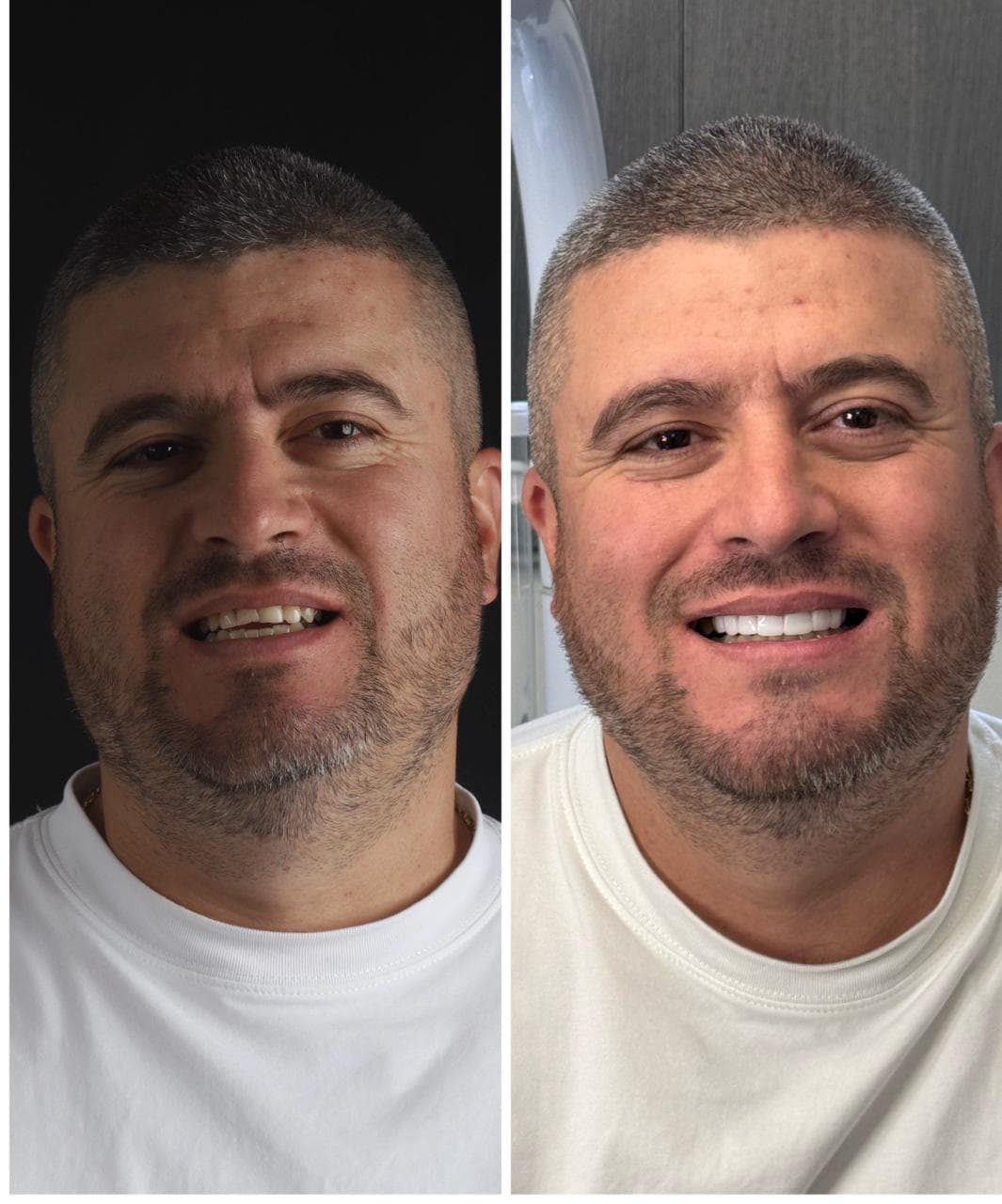 Caso real de diseño de sonrisa — antes y después