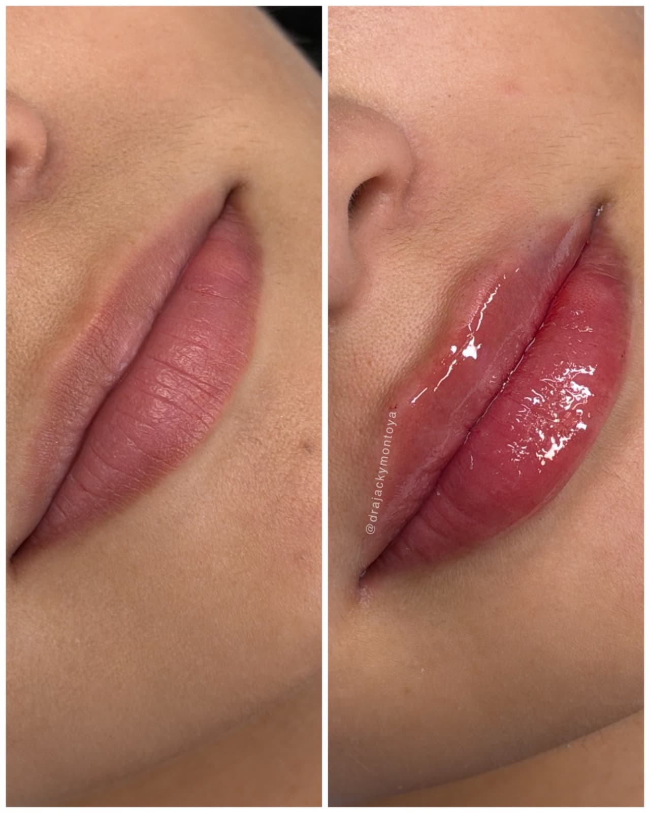 Caso real de armonización de labios — antes y después
