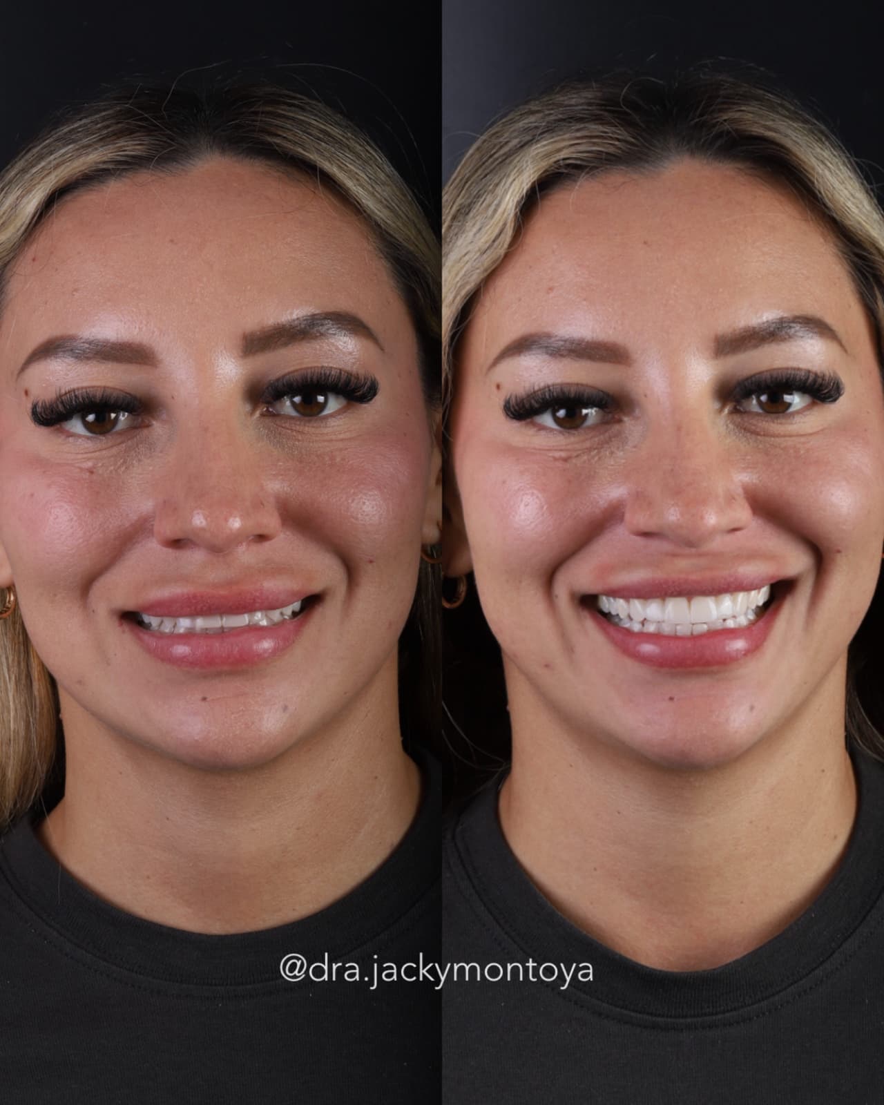 Caso real de microdiseño de sonrisa — antes y después